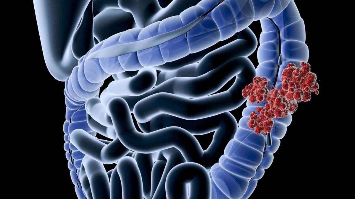 cancer de colon